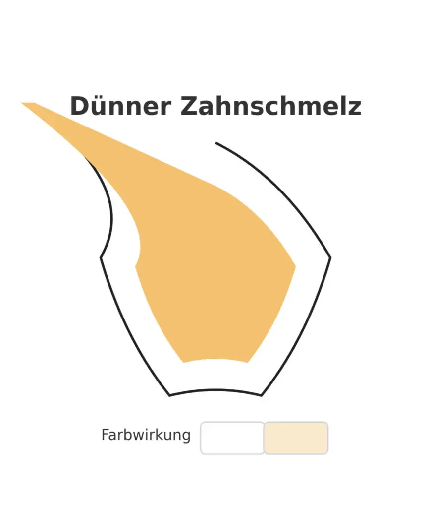 Schematische Darstellung eines Zahns mit dünnem Zahnschmelz und seiner Farbwirkung