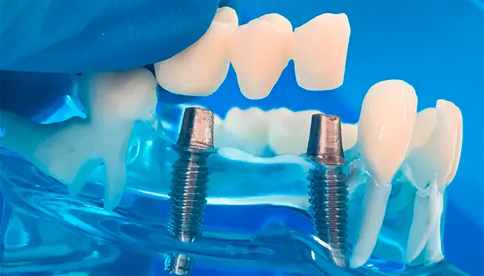 brucke-auf-implantate-1-01