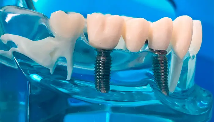 brucke-auf-implantate-2.62862b252384b