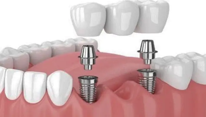 implantat-brucke-rot-01-01
